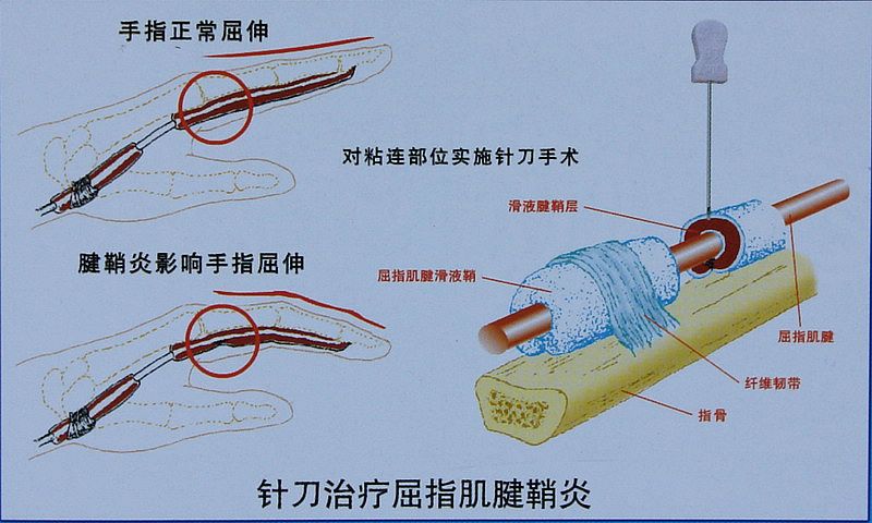 小针刀治疗屈指肌腱鞘炎_好大夫在线